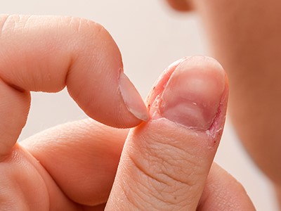 Pielita rupta la unghii: cauze si cum o tratezi